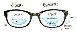 Diagram drawn by Sophy Wong, MD, showing a bifocal lens on the left with a small near section at the bottom of single distance vision lenses. On the right is a progressive lens showing a gradual corridor changing from the distance prescription in the top half to intermediate to the near prescription at the bottom.
